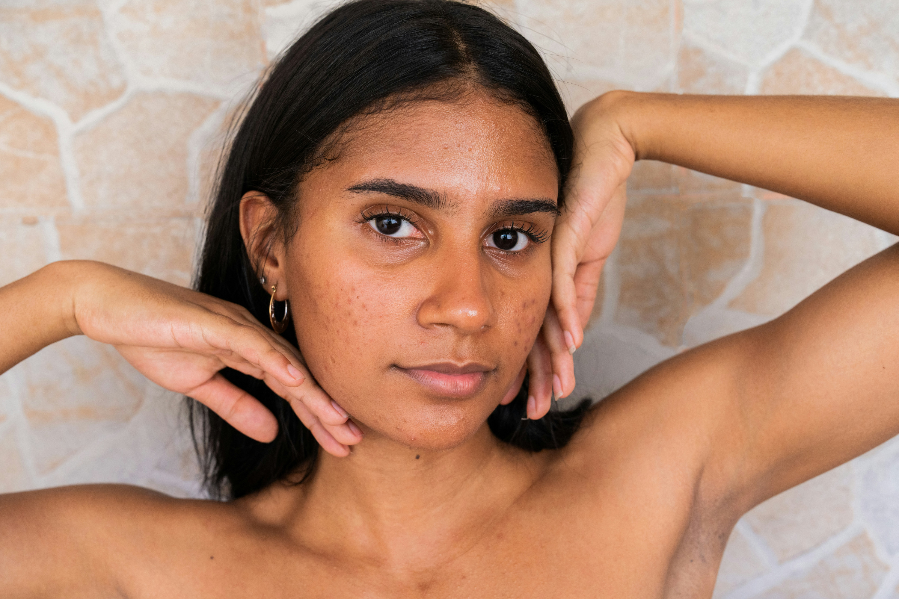 Routine coréenne pour peau acnéique : comprendre et traiter sans agresser